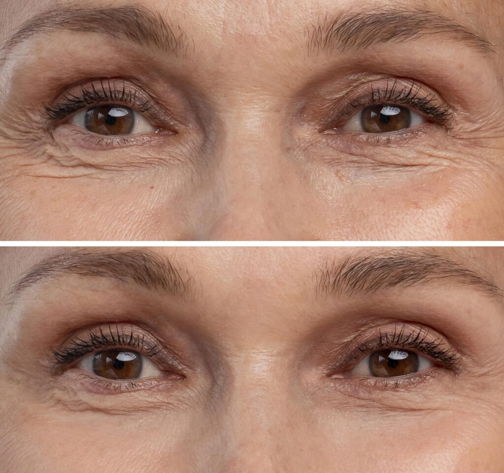 Blepharoplasty vs. Upneeq