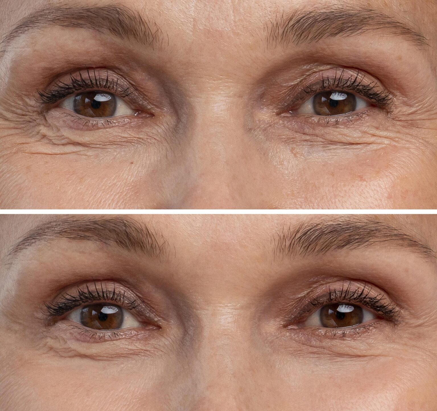 Blepharoplasty vs. Upneeq