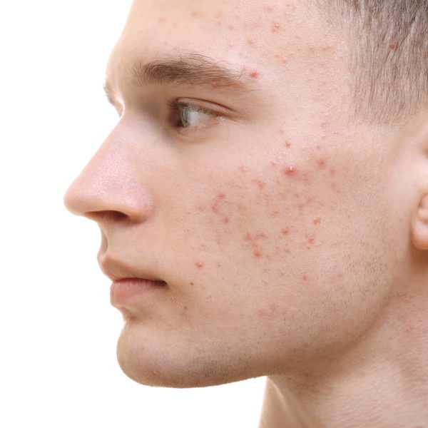 Handsome young man with problem skin on white background