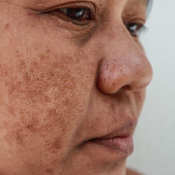 Skin problem, Closeup skin face asian women with spot melasma,  Dark spots, freckles, pigmentation  Skincare problem concept.