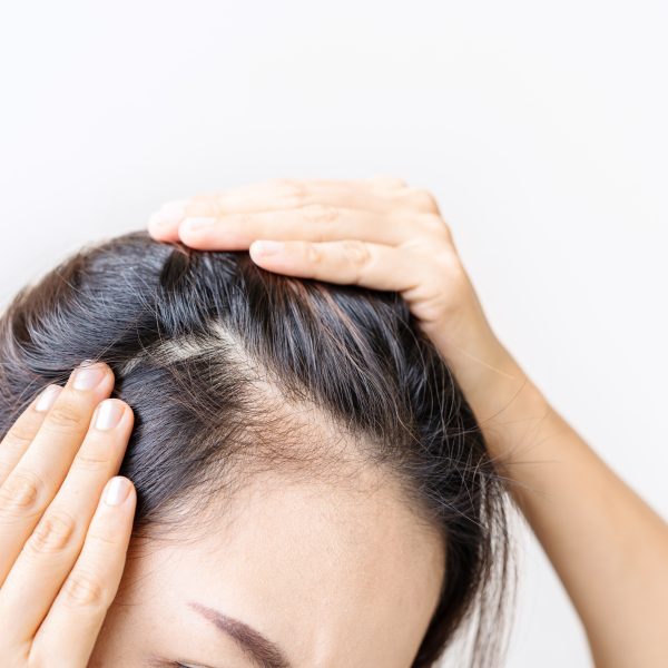 Young asian women worried about hair loss problems, Hiar care concept Young asian women worried about hair loss problems, Hiar care concept